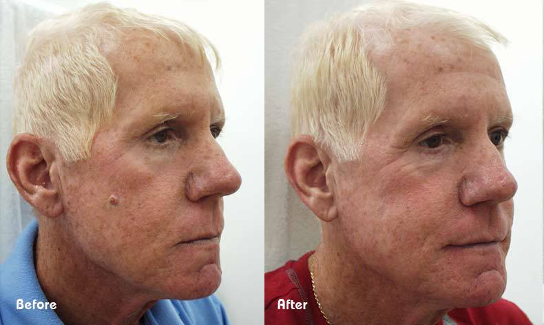 Wart before and after cryotherapy removal — Beau Synergy Ltd